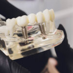 implanty zębów lubin