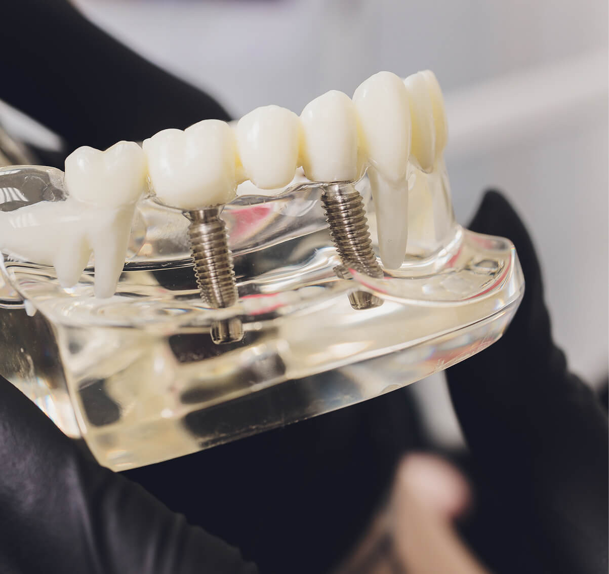 implanty zębów lubin